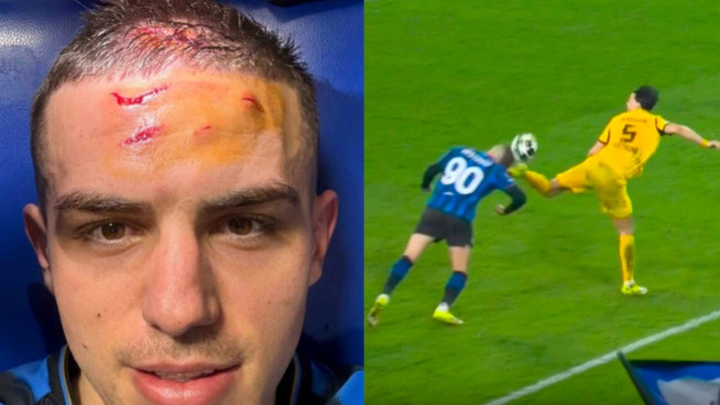 Nikola Krstović van Atalanta laat zijn voorhoofd zien na een dramatische penalty in de laatste minuut tegen BVB